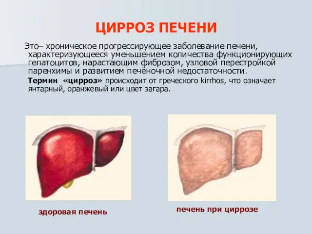 ЦИРРОЗ ПЕЧЕНИ Это– хроническое прогрессирующее заболевание печени, характеризующееся уменьшением количества функционирующих