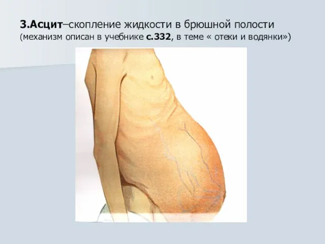 3.Асцит–скопление жидкости в брюшной полости (механизм описан в учебнике с.332, в теме « отеки и водянки»)