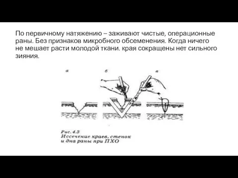 По первичному натяжению – заживают чистые, операционные раны. Без признаков микробного