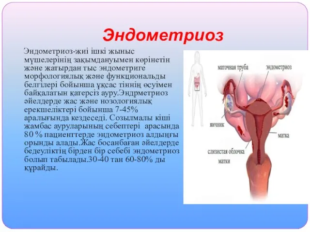 Эндометриоз Эндометриоз-жиі ішкі жыныс мүшелерінің зақымдануымен көрінетін және жатырдан тыс эндометриге