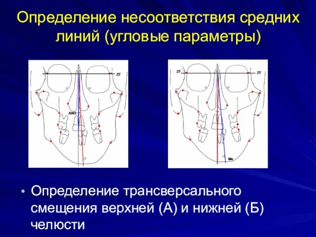 Определение несоответствия средних линий (угловые параметры) Определение трансверсального смещения верхней (А) и нижней (Б) челюсти