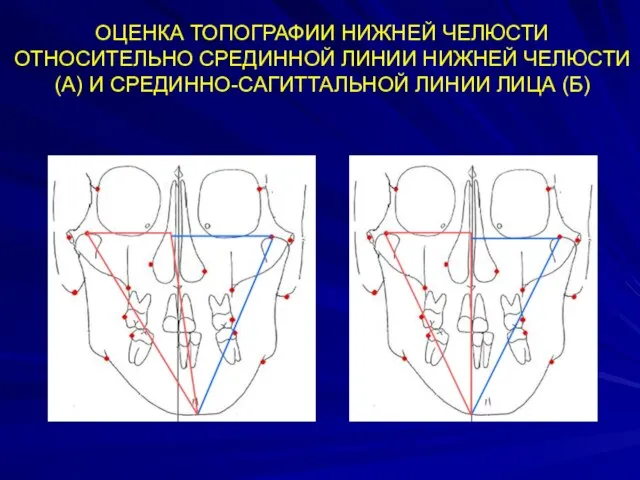 ОЦЕНКА ТОПОГРАФИИ НИЖНЕЙ ЧЕЛЮСТИ ОТНОСИТЕЛЬНО СРЕДИННОЙ ЛИНИИ НИЖНЕЙ ЧЕЛЮСТИ (А) И СРЕДИННО-САГИТТАЛЬНОЙ ЛИНИИ ЛИЦА (Б)