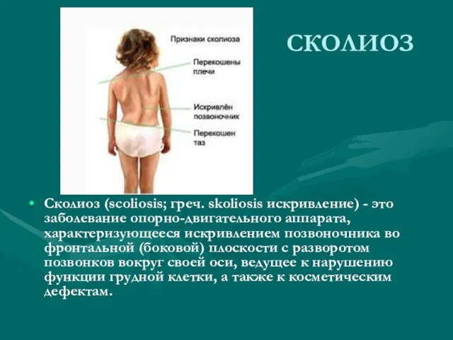 СКОЛИОЗ Сколиоз (scoliosis; греч. skoliosis искривление) - это заболевание опорно-двигательного аппарата,