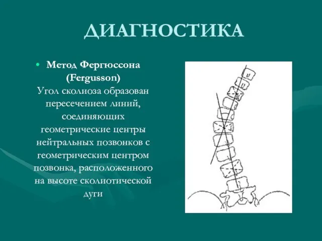 ДИАГНОСТИКА Метод Фергюссона (Fergusson) Угол сколиоза образован пересечением линий, соединяющих геометрические