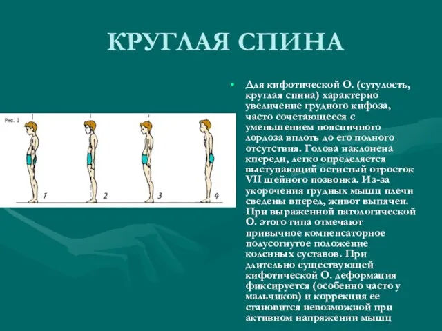 КРУГЛАЯ СПИНА Для кифотической О. (сутулость, круглая спина) характерно увеличение грудного