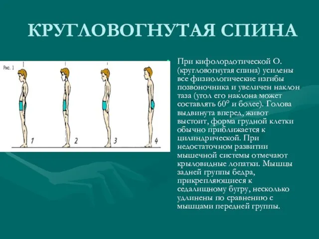 КРУГЛОВОГНУТАЯ СПИНА При кифолордотической О. (кругловогнугая спина) усилены все физиологические изгибы