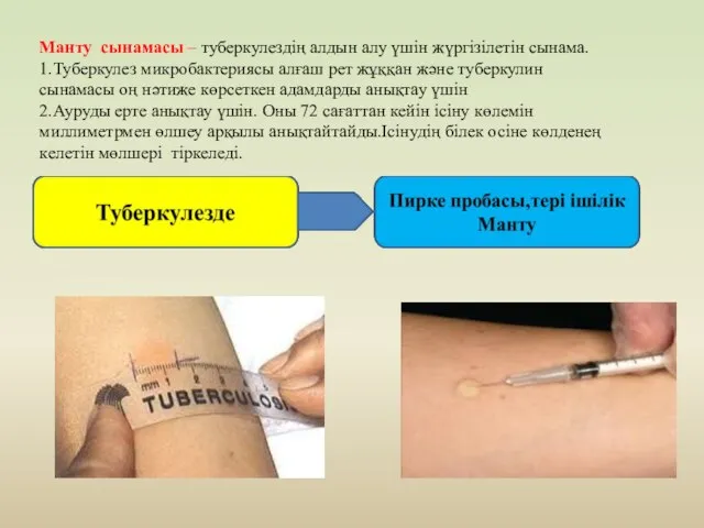 Манту сынамасы – туберкулездің алдын алу үшін жүргізілетін сынама. 1.Туберкулез микробактериясы