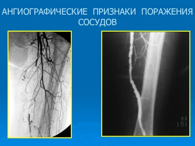 АНГИОГРАФИЧЕСКИЕ ПРИЗНАКИ ПОРАЖЕНИЯ СОСУДОВ