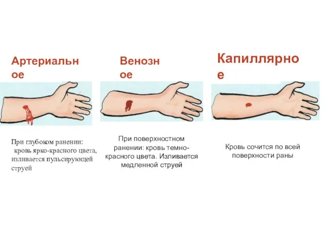 Артериальное При глубоком ранении: кровь ярко-красного цвета, изливается пульсирующей струей Венозное