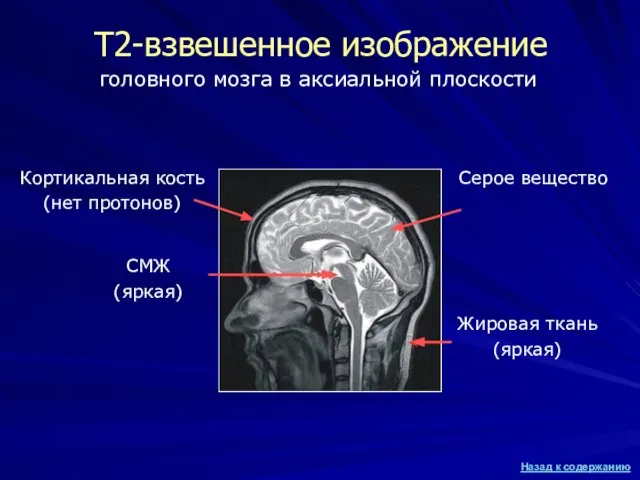 Т2-взвешенное изображение СМЖ (яркая) Жировая ткань (яркая) Кортикальная кость (нет протонов)