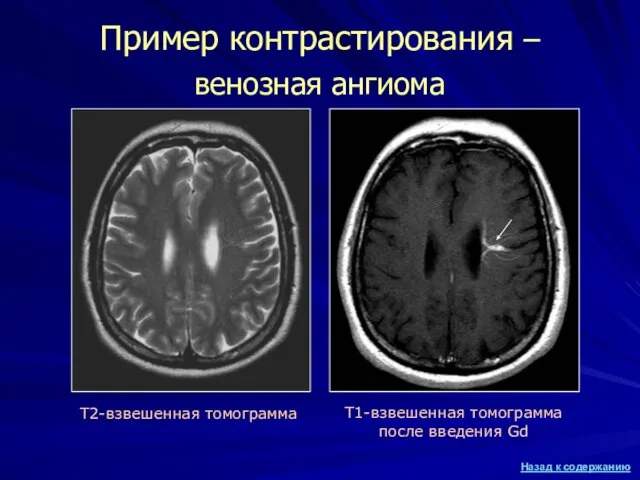 Т2-взвешенная томограмма Т1-взвешенная томограмма после введения Gd Пример контрастирования – венозная ангиома