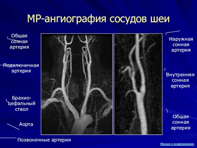 МР-ангиография сосудов шеи Аорта Брахио-цефальный ствол Общая сонная артерия Подключичная артерия