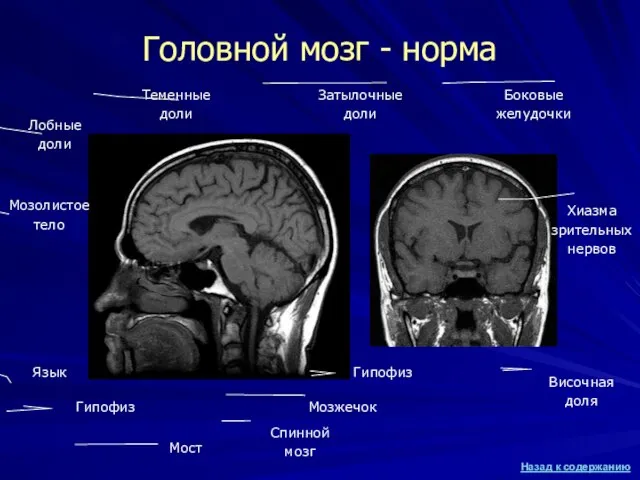 Головной мозг - норма Язык Спинной мозг Мозжечок Мост Гипофиз Лобные