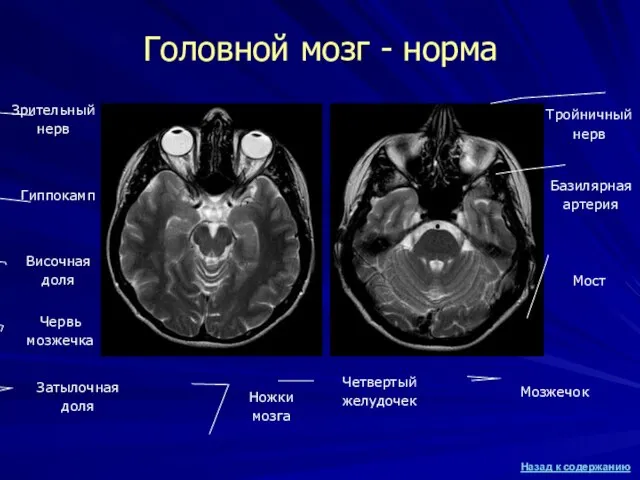 Головной мозг - норма Затылочная доля Червь мозжечка Ножки мозга Гиппокамп