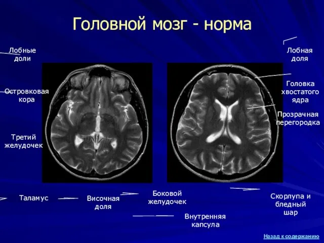 Головной мозг - норма Лобные доли Третий желудочек Островковая кора Таламус