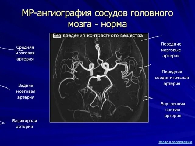 МР-ангиография сосудов головного мозга - норма Без введения контрастного вещества Средняя