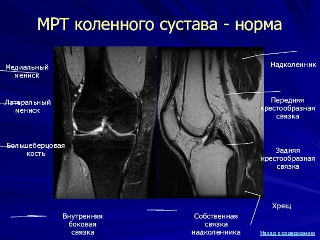 МРТ коленного сустава - норма Большеберцовая кость Задняя крестообразная связка Передняя