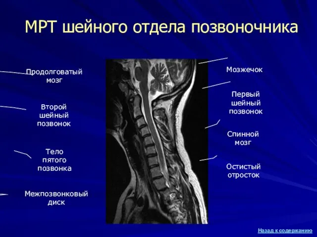 МРТ шейного отдела позвоночника Продолговатый мозг Спинной мозг Второй шейный позвонок