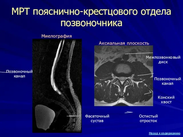 МРТ пояснично-крестцового отдела позвоночника Миелография Аксиальная плоскость Позвоночный канал Остистый отросток