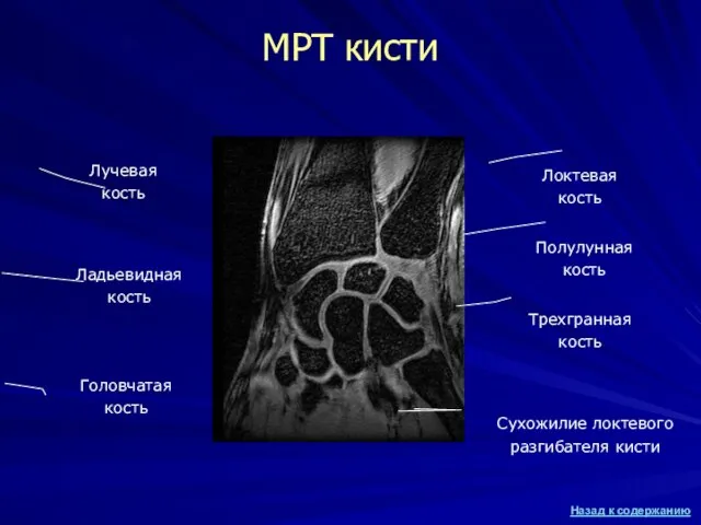 МРТ кисти Лучевая кость Локтевая кость Ладьевидная кость Полулунная кость Трехгранная