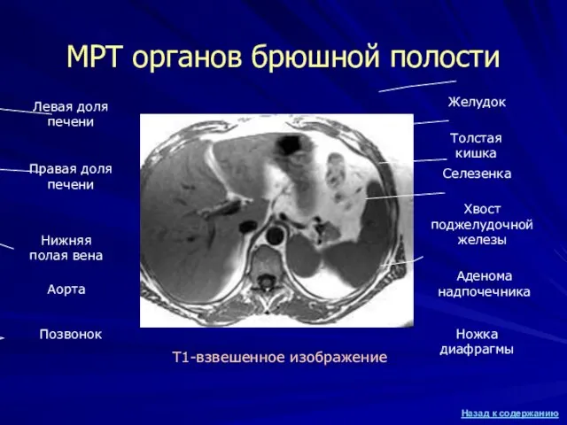 МРТ органов брюшной полости Т1-взвешенное изображение Правая доля печени Левая доля