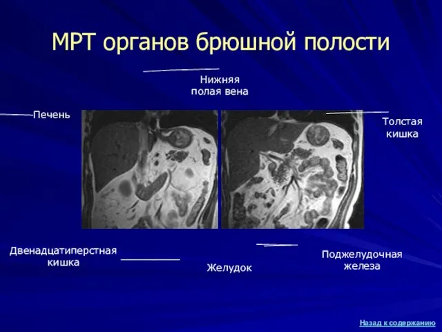 МРТ органов брюшной полости Двенадцатиперстная кишка Печень Нижняя полая вена Желудок Поджелудочная железа Толстая кишка