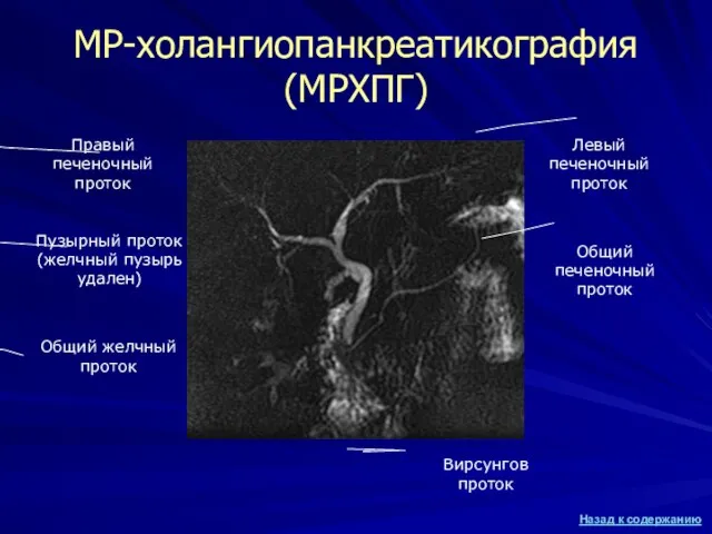 МР-холангиопанкреатикография (МРХПГ) Общий желчный проток Вирсунгов проток Пузырный проток (желчный пузырь