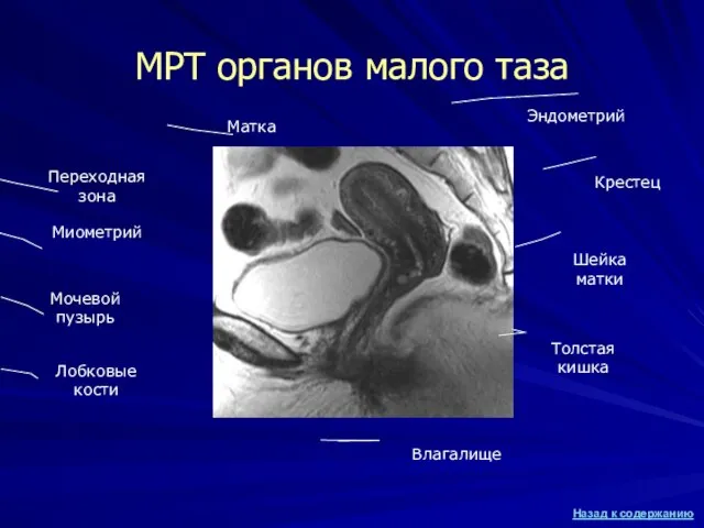 МРТ органов малого таза Мочевой пузырь Матка Лобковые кости Толстая кишка