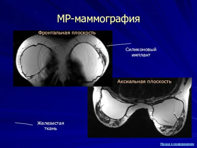 МР-маммография Силиконовый имплант Железистая ткань Фронтальная плоскость Аксиальная плоскость