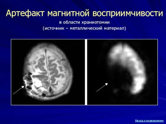 Артефакт магнитной восприимчивости в области краниотомии (источник – металлический материал)