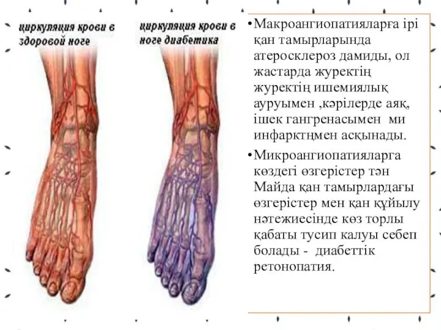 Макроангиопатияларға ірі қан тамырларында атеросклероз дамиды, ол жастарда журектің журектің ишемиялық