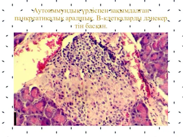 Аутоиммундық үрдіспен зақымдалған панкреатикалық аралшық. В-клеткаларды дәнекер тін басқан.