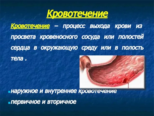 Кровотечение Кровотечение – процесс выхода крови из просвета кровеносного сосуда или