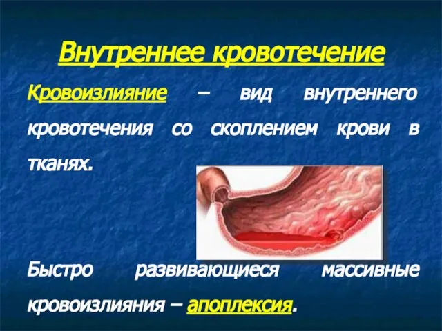 Внутреннее кровотечение Кровоизлияние – вид внутреннего кровотечения со скоплением крови в