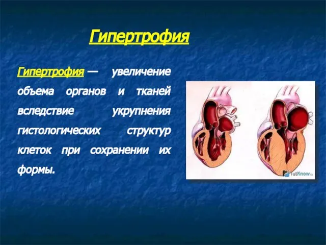 Гипертрофия — увеличение объема органов и тканей вследствие укрупнения гистологических структур