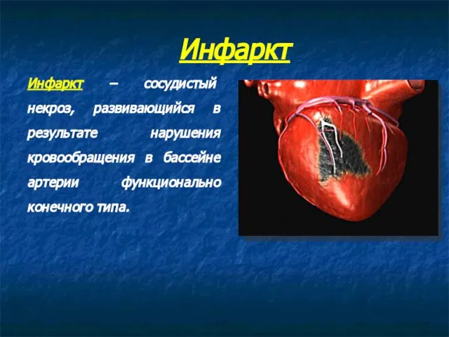 Инфаркт – сосудистый некроз, развивающийся в результате нарушения кровообращения в бассейне артерии функционально конечного типа. Инфаркт