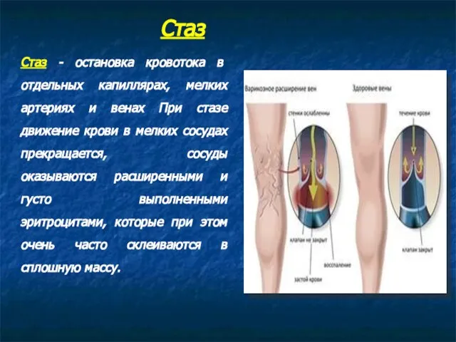 Стаз - остановка кровотока в отдельных капиллярах, мелких артериях и венах