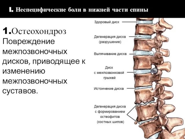 1.Остеохондроз Повреждение межпозвоночных дисков, приводящее к изменению межпозвоночных суставов. I. I.