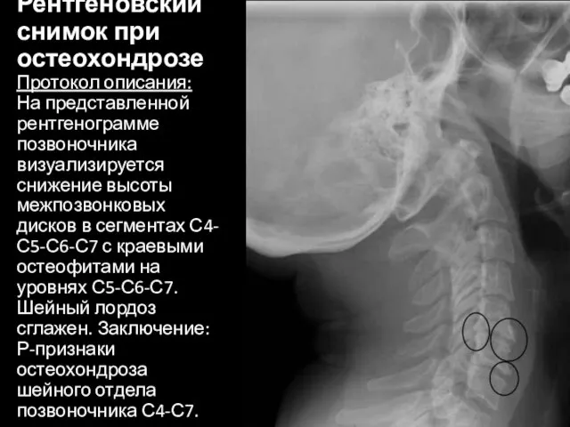 Рентгеновский снимок при остеохондрозе Протокол описания: На представленной рентгенограмме позвоночника визуализируется