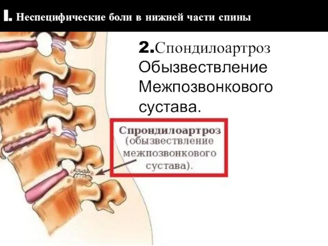 I. Неспецифические боли в нижней части спины 2.Спондилоартроз Обызвествление Межпозвонкового сустава.