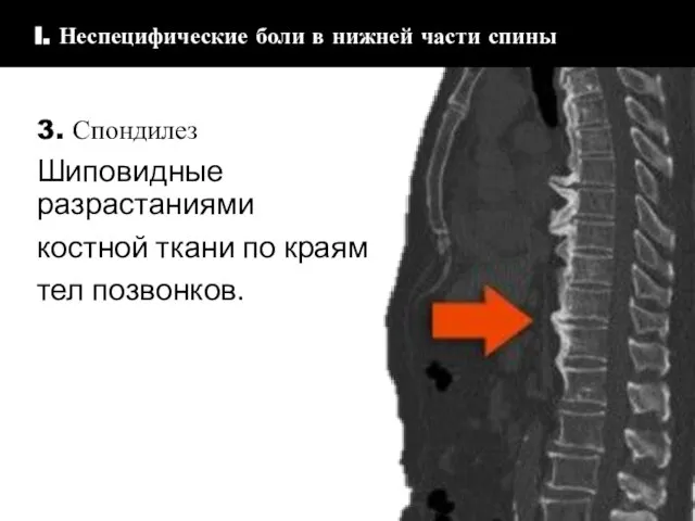 3. Спондилез Шиповидные разрастаниями костной ткани по краям тел позвонков. I.