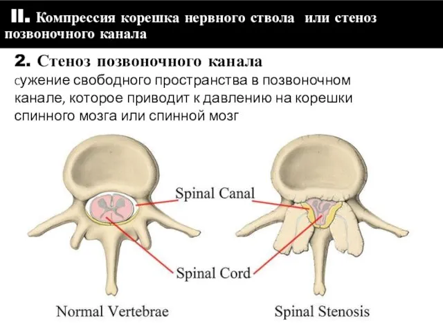 III. Компрессия корешка нервного ствола или стеноз позвоночного канала 2. Стеноз