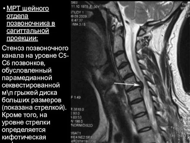 МРТ шейного отдела позвоночника в сагиттальной проекции: Стеноз позвоночного канала на