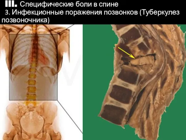 IIII. Специфические боли в спине 3. Инфекционные поражения позвонков (Туберкулез позвоночника)