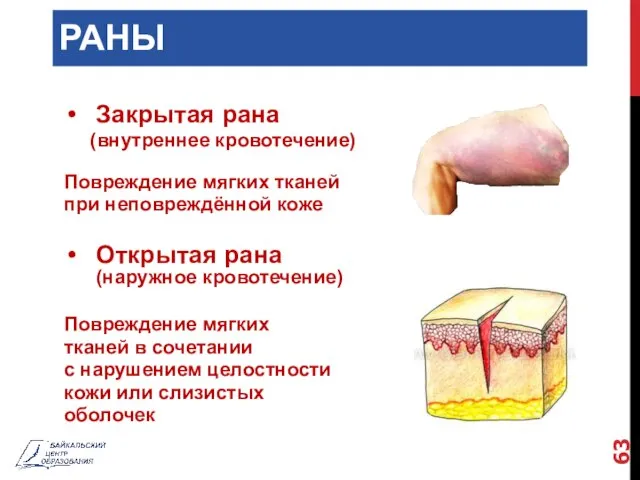 РАНЫ Закрытая рана (внутреннее кровотечение) Повреждение мягких тканей при неповреждённой коже