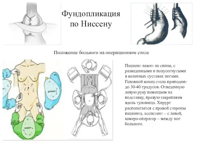 Фундопликация по Ниссену Пациент лежит на спине, с разведенными и полусогнутыми