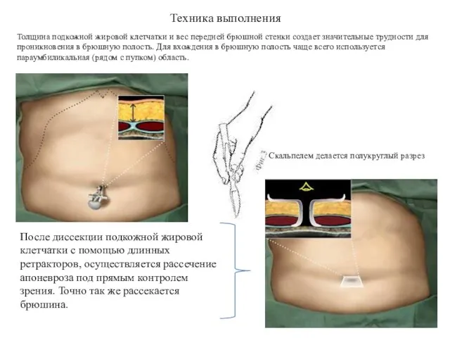 Техника выполнения Толщина подкожной жировой клетчатки и вес передней брюшной стенки