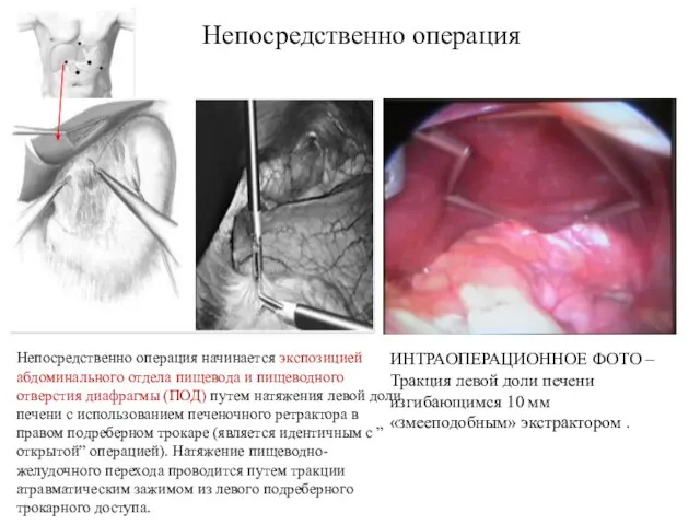 Непосредственно операция ИНТРАОПЕРАЦИОННОЕ ФОТО – Тракция левой доли печени изгибающимся 10