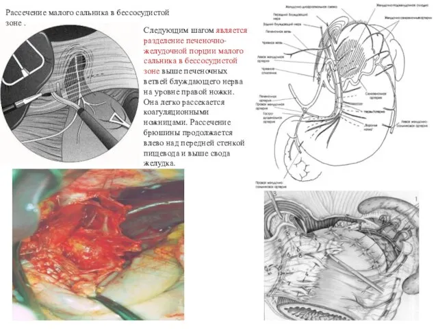 Рассечение малого сальника в бессосудистой зоне . Следующим шагом является разделение