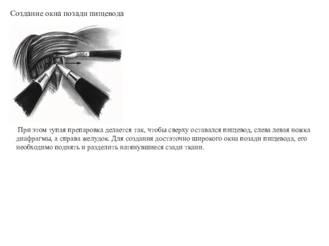 При этом тупая препаровка делается так, чтобы сверху оставался пищевод, слева